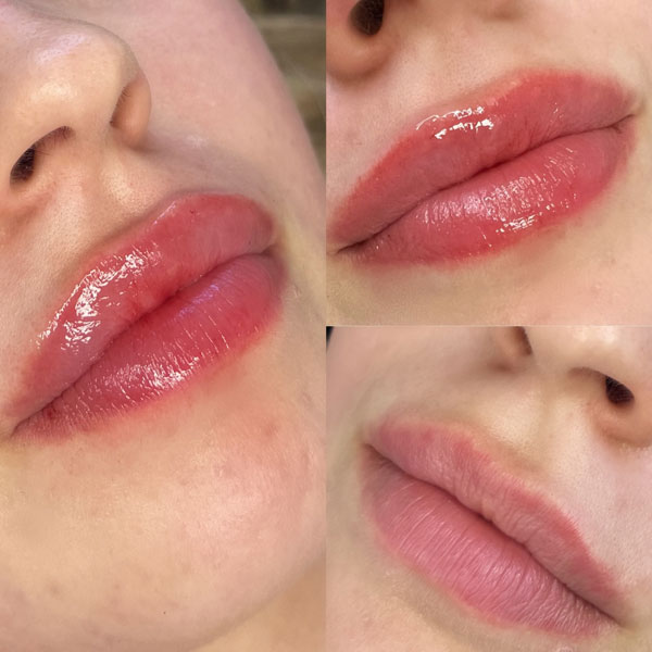 filler-lips