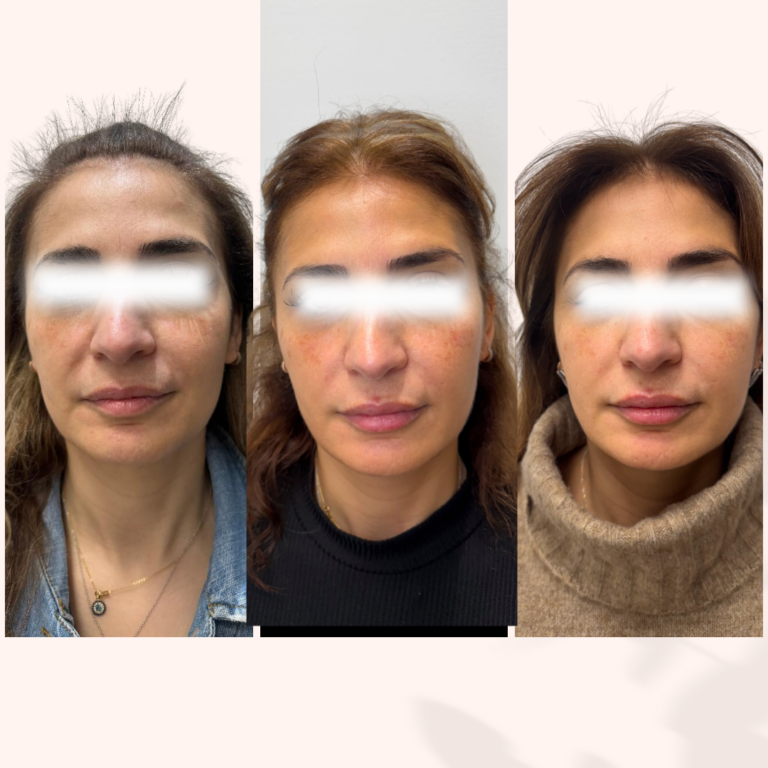 sculptra pogression sans text