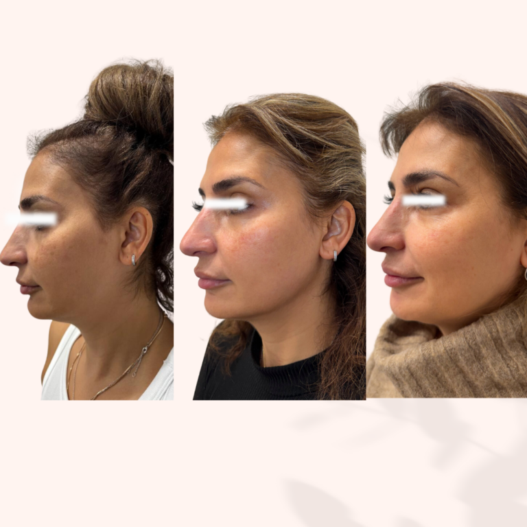 sculptra progression 2 sans texte