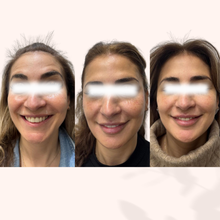 sculptra progression smiling sans text e