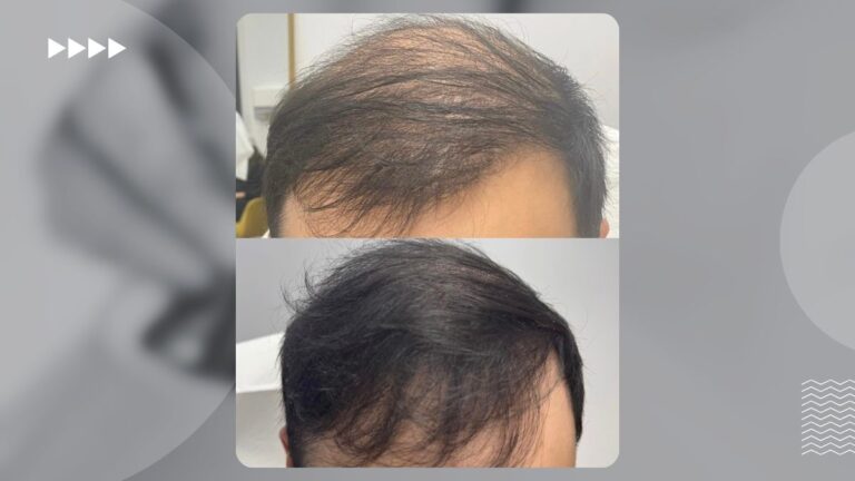 traitement prp cheveux pour stimuler la repousse capillaire